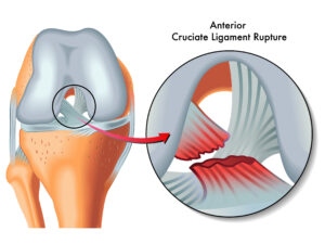 Cedera ACL & Meniscus