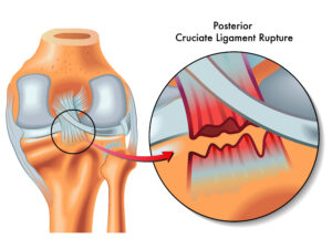 Cedera PCL & Multi-ligamen