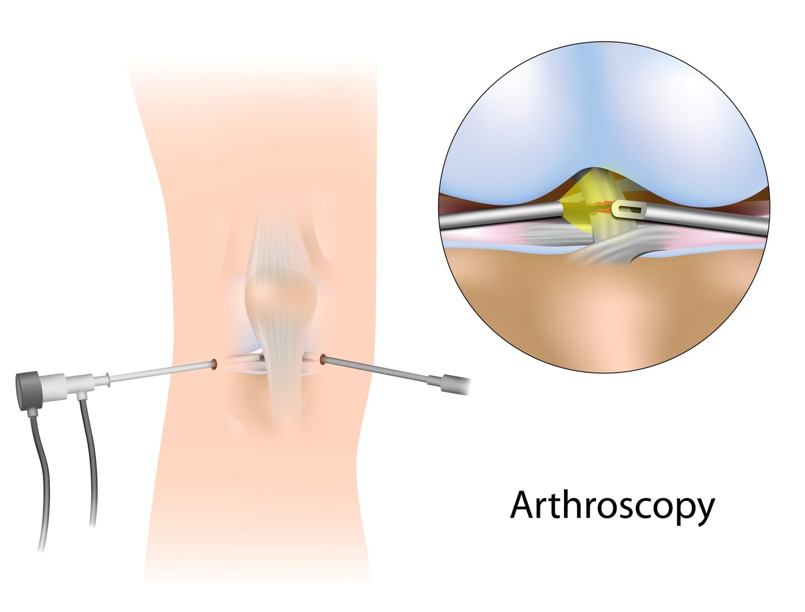 Arthroscopic Anatomical ACL Reconstruction – Ortho Penang
