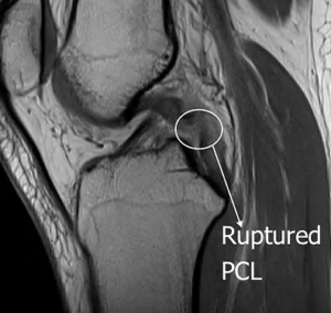 PCL & Multi-ligament Reconstruction