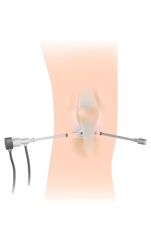 Arthroscopy knee