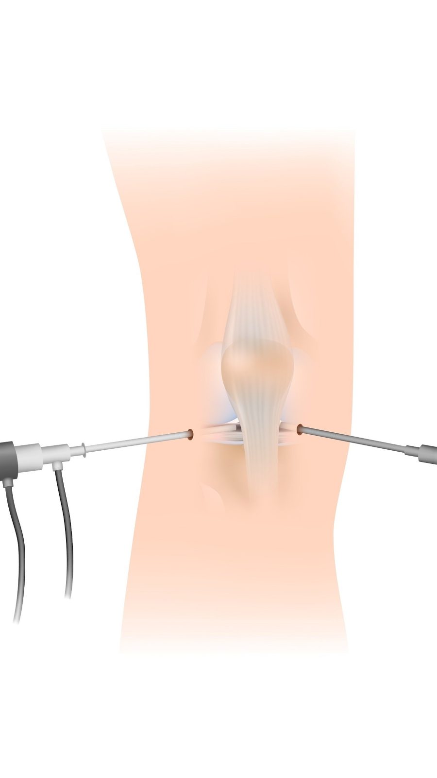 Arthroscopy knee