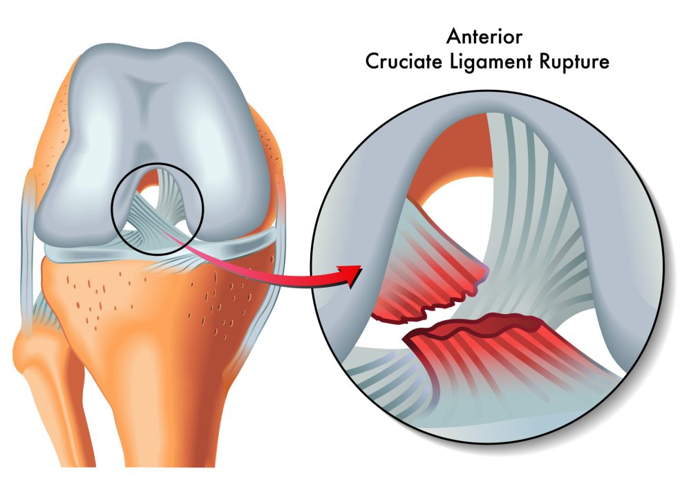 acl ortho