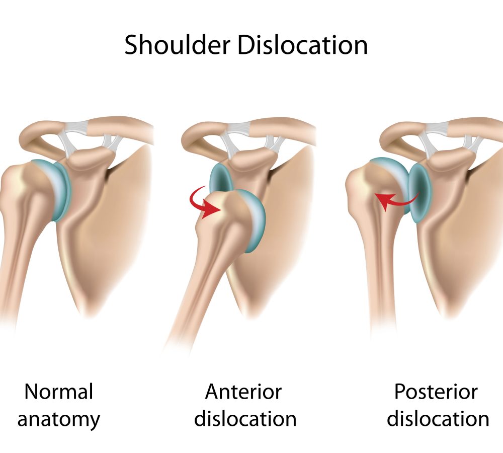 shoulder dislocation