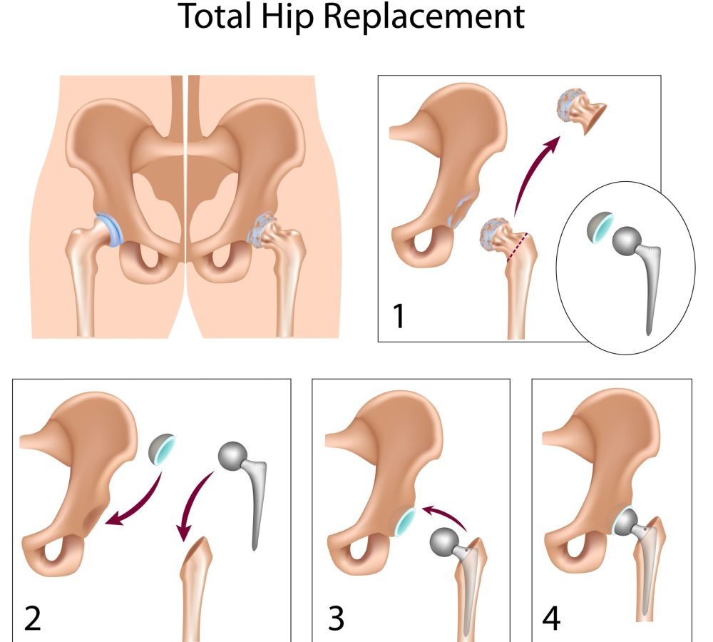 total hip replacement